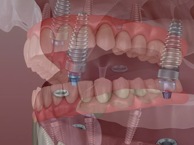 Kramer and Kramer Dental | Root Canals, Dentures and Oral Exams