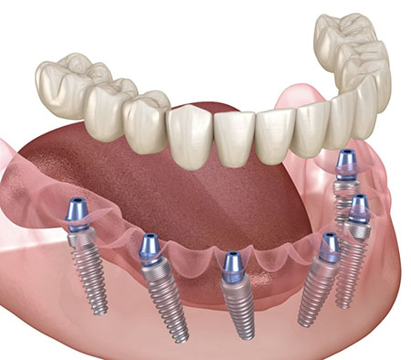 Kramer and Kramer Dental | Lumineers reg , Periodontal Treatment and Veneers