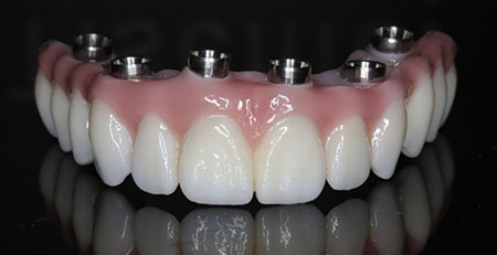 Kramer and Kramer Dental | Crowns  amp  Caps, Lumineers reg  and Dental Bridges