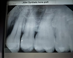 Kramer and Kramer Dental | Cosmetic Dentistry, All-on-4 reg and Ceramic Crowns