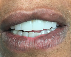 Kramer and Kramer Dental | All-on-6 reg , Oral Exams and Veneers