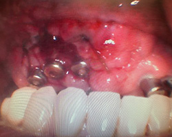 Kramer and Kramer Dental | Crowns amp Caps, All-on-4 reg and Teeth Whitening