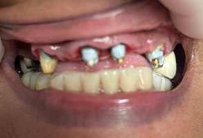 Kramer and Kramer Dental | Implant Dentistry, Extractions and Dentures