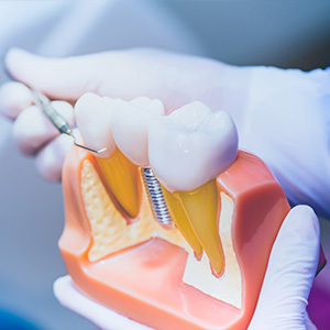 Kramer and Kramer Dental | Root Canals, Crowns  amp  Caps and Dental Fillings