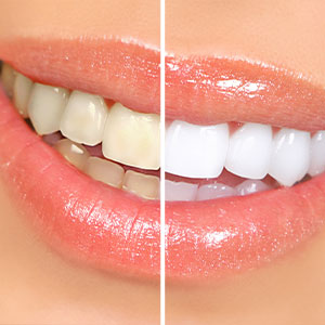Kramer and Kramer Dental | Periodontal Treatment, Root Canals and Sleep Apnea