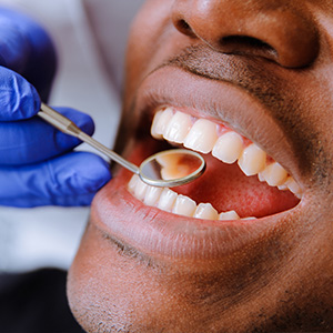 Kramer and Kramer Dental | Lumineers reg , Veneers and Pediatric Dentistry
